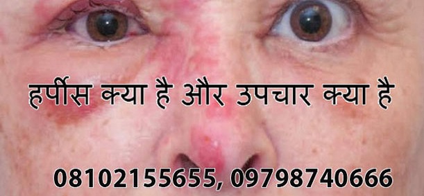 best medicines and treatment for herpes simplex virus