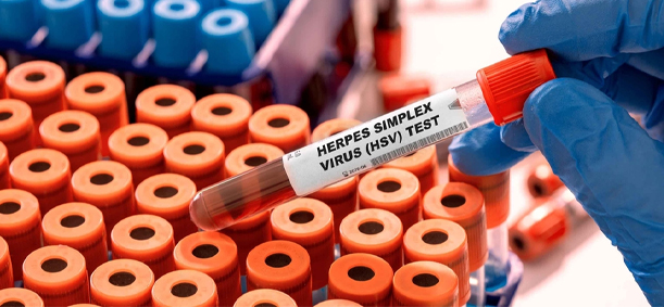 हर्पीस सिम्प्लेक्स का इलाज | भगवती आयुर्वेद आयुर्वेदिक उपचार